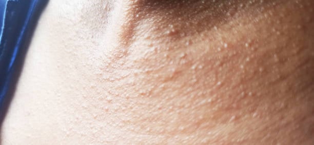 Heat Rash: हीट रैश की समस्या क्या है? जानिए हीट रैश के लक्षण और इलाज!