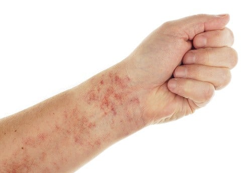 Petechiae: पेटीचिया क्या है? जानिए पेटीचिया के लक्षण, कारण और इलाज!