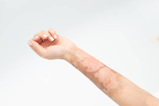 Burn Scars: जानिए जलने के निशान को दूर करने के उपाय!