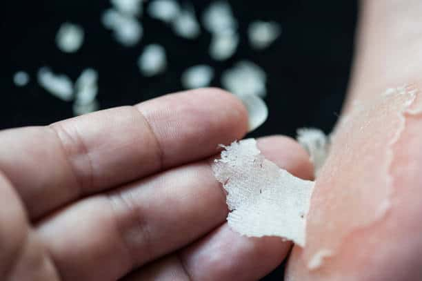 Peeling feet: पैरों में होने वाली इस परेशानी के बारे में पाएं पूरी इंफॉर्मेशन!