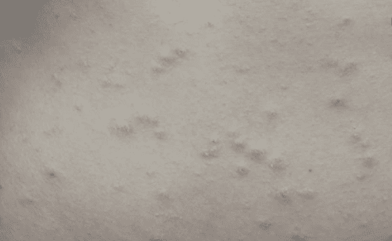 Stomach Pimples: स्टमक पिंपल की हो जाए समस्या, तो क्या करना चाहिए समाधान?