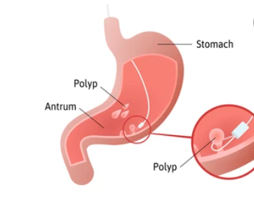 Antrum: एंट्रम का क्या होता है मतलब, कौन-सी मेडिकल कंडीशन इसे कर सकती है प्रभावित?