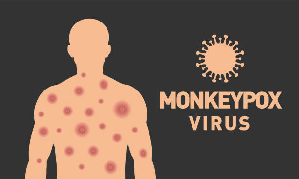 Monkeypox virus: मंकीपॉक्स वायरस क्या है? इस वायरस से डरे नहीं, बल्कि रहें सतर्क!