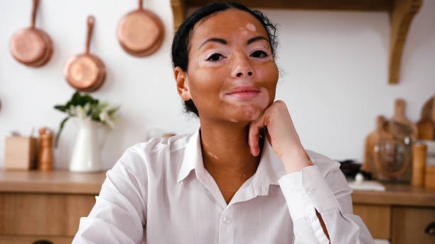 Vitiligo On Black Skin: काली त्वचा पर विटिलिगो की समस्या क्या है? जानते विटिलिगो यानी सफेद दाग से जुड़ी महत्वपूर्ण जानकारी!