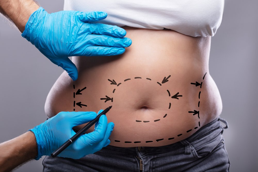 Tummy Tuck Scarring: टमी टक स्कारिंग क्या है? जानिए इससे जुड़ी पूरी जानकरी!