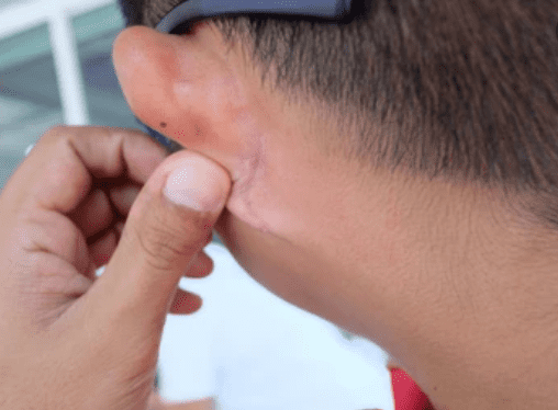 Ear eczema: ईयर एक्जिमा के क्या हैं कारण, जानिए दिख सकते लक्षण?