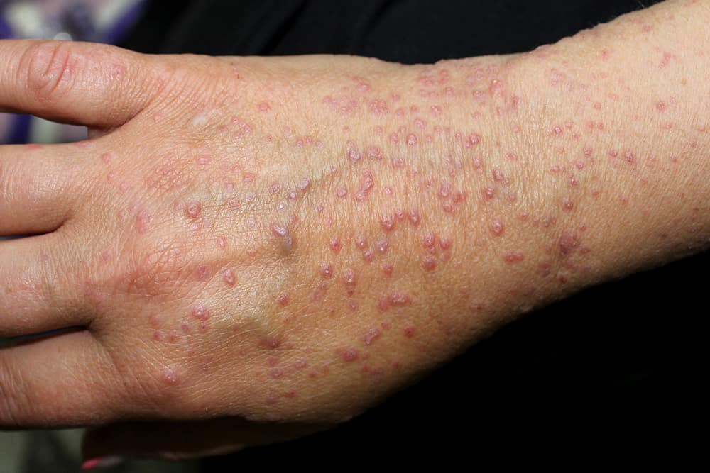 लाइकेन प्लानस : इस स्किन कंडिशन के बारे में जानते हैं आप? इसको ठीक होने लग जाते हैं वर्षों