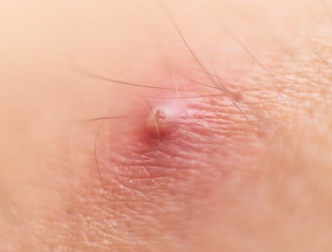Boils on the Inner Thigh: जानिए भीतरी जांघ पर फोड़े के 17 कारण और बचाव के टिप्स!