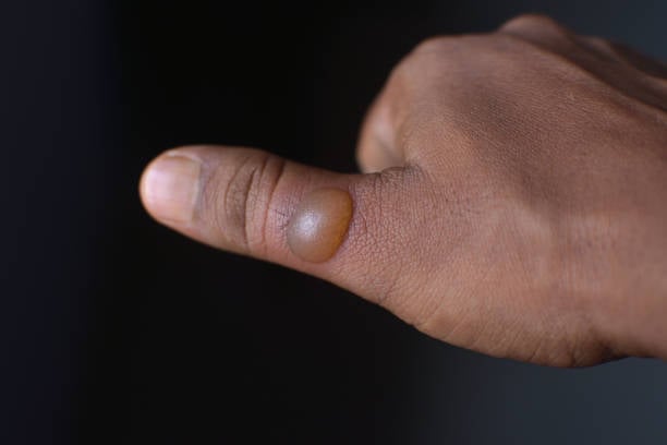 उबलते हुए पानी से जलना (Boiling Water Burns): जानिए क्या है बॉयलिंग वॉटर बर्न का इलाज!