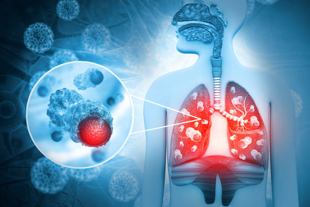 Metastatic lung cancer: मेटास्टेटिक लंग कैंसर क्या हैं? जानिए मेटास्टेटिक लंग कैंसर के लक्षण और इलाज से जुड़ी प्रमुख जानकारियां!