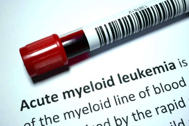Acute Myeloid Leukemia rash: जानिए एक्यूट मायलोइड ल्यूकेमिया रैश के लक्षण और इससे जुड़ी महत्वपूर्ण जानकारी!