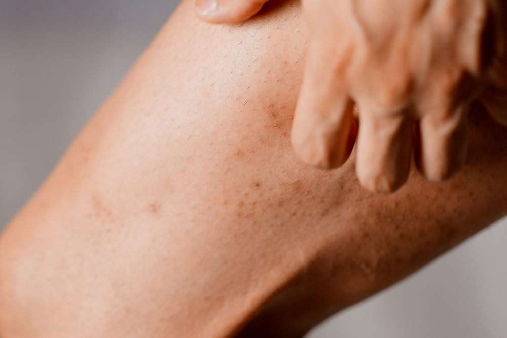 इनर थाईज में रैशेज (Rashes On The Inner Thighs) के इन 9 कारणों के बारे में जान लें