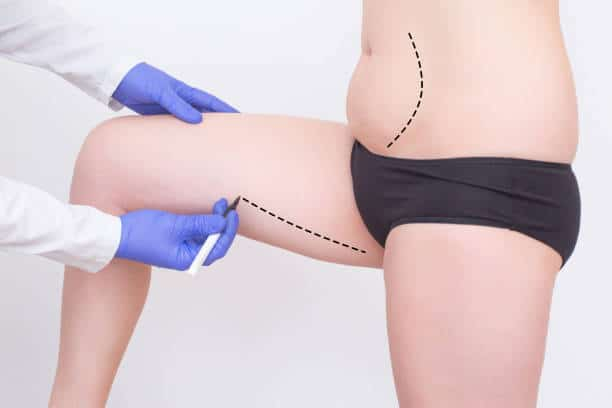 Liposuction and Tummy Tuck: लिपोसक्शन और टमी टक दोनों है अलग सर्जिकल प्रोसेस, जानिए कब किसकी पड़ सकती है जरूरत!