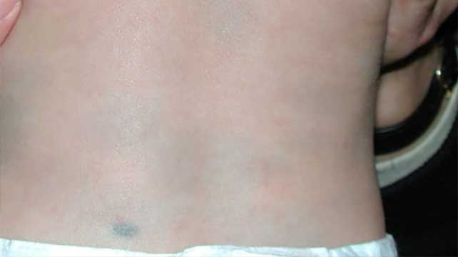 Mongolian Blue Spots: क्या शरीर पर पड़ने वाले नीले स्पॉट्स हार्मफुल होते हैं?