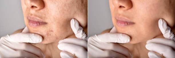 Dark Spots caused by Pimples: पिंपल्स के कारण डार्क स्पॉट्स के लिए अपनायें ये टिप्स और पिंपल एवं डार्क स्पॉट्स दोनों को कहें गुड बॉय!