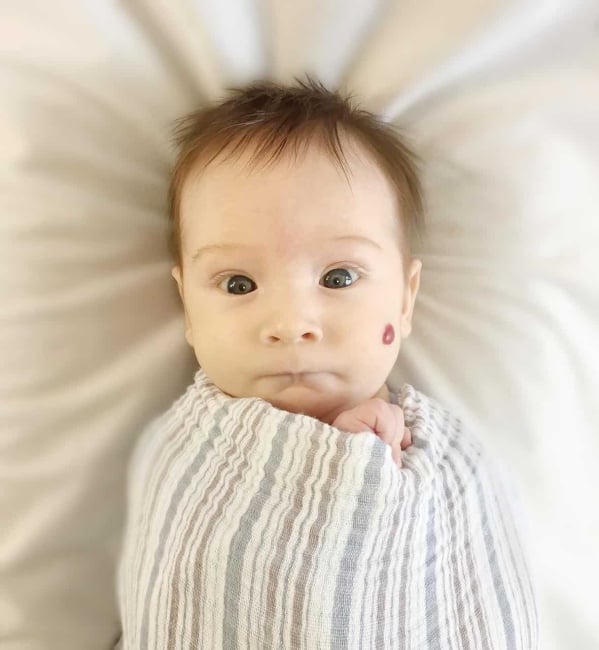 हेमानजियोमस (Hemangiomas) : क्या आप जानते हैं इस सामान्य से दिखने वाली स्किन कंडिशन के बारे में