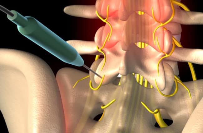 रेडियोफ्रीक्वेंसी एब्लेशन क्या है और कब किया जाता है? जानिए यहां...