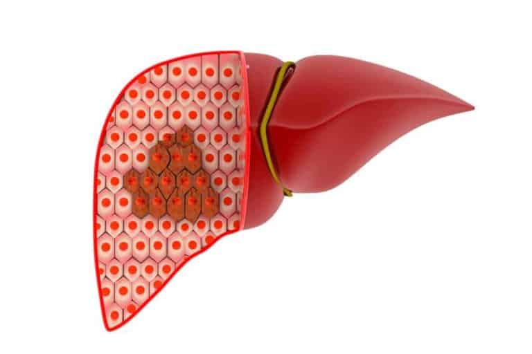 स्टेज 1 लिवर कैंसर (Stage 1 liver cancer) और इसके इलाज के बारे में जानें